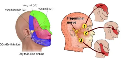 Đau dây thần kinh số 5