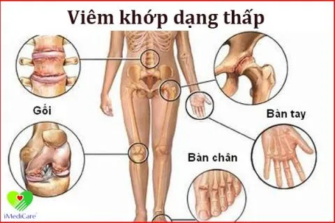 Viêm khớp dạng thấp (Chứng tý)